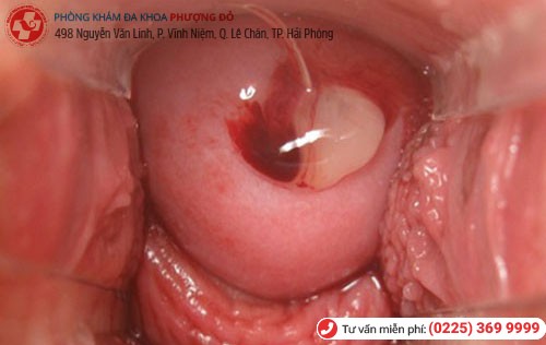 Hình ảnh Polyp cổ tử cung