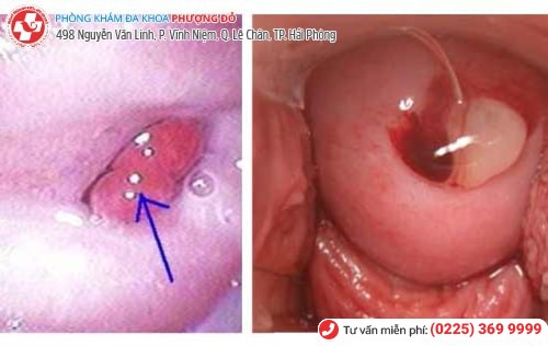 Hình ảnh Polyp cổ tử cung