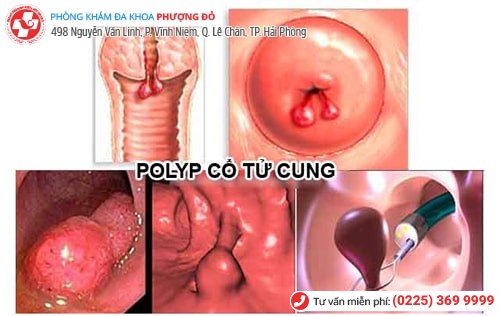 Polyp cổ tử cung khiến kinh nguyệt ra nhiều