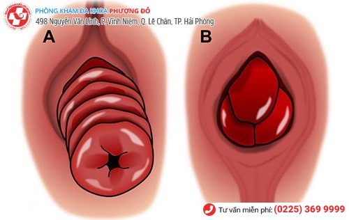 Hình ảnh tử cung bị sa xuống