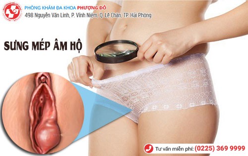 Sưng mép âm hộ