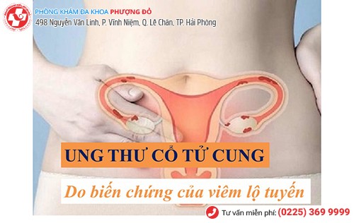 Viêm lộ tuyến cổ tử cung ở mức độ nặng có thể dẫn đến ung thư cổ tử cung