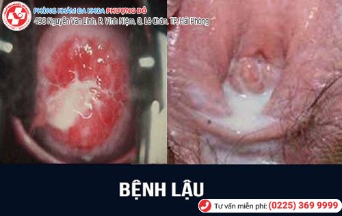 Tiểu ra máu ở phụ nữ là bệnh gì?