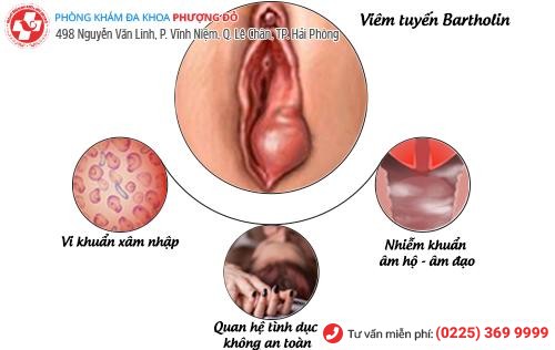 U cục sưng cứng gần âm đạo – Triệu chứng của viêm tuyến Bartholin