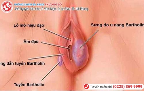 U cục sưng cứng gần âm đạo – Triệu chứng của viêm tuyến Bartholin