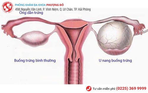 U nang buồng trứng dẫn đến những cơn đau bụng kinh dữ dội