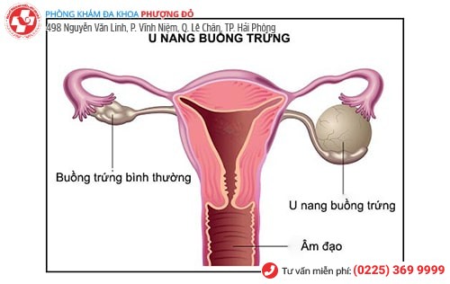 Hình ảnh u nang buồng trứng