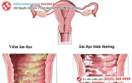 Viêm âm đạo gây ra những biến chứng nguy hiểm