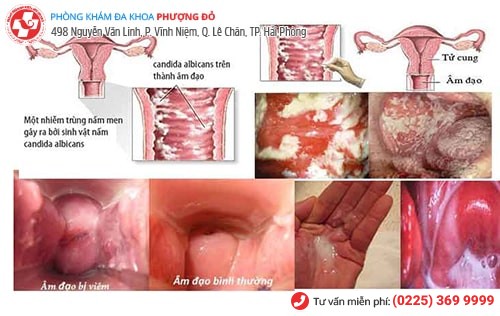 Viêm âm đạo khiến chị em bị ra máu khi quan hệ