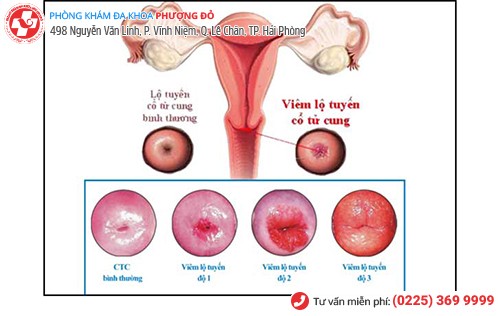 Các cấp độ lộ tuyến tử cung bị viêm