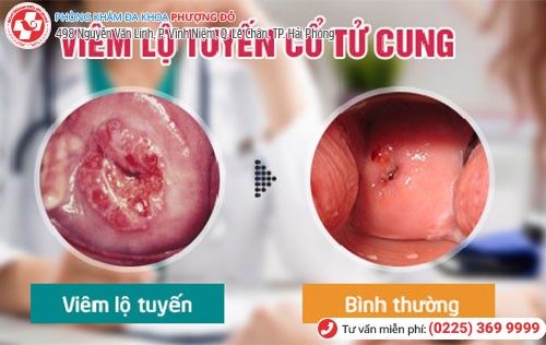 Hình ảnh lộ tuyến cổ tử cung bị viêm