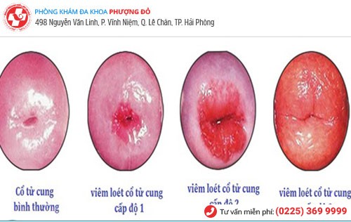 Hình ảnh viêm loét cổ tử cung