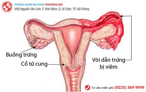 Viêm vòi trứng