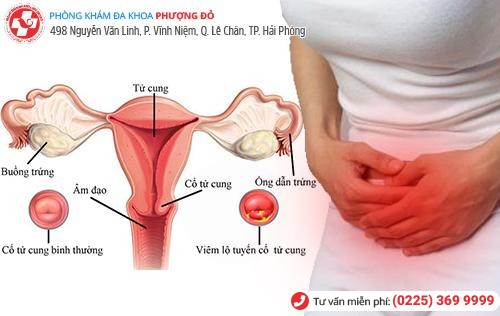 Vô sinh vì không hay biết về bệnh viêm tử cung