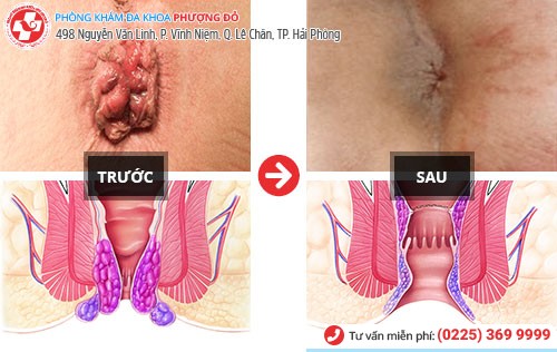 Kết quả cắt trĩ