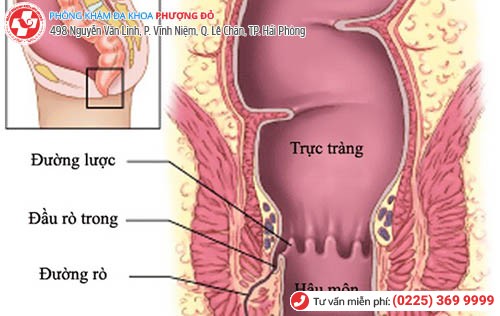 Các bệnh về hậu môn