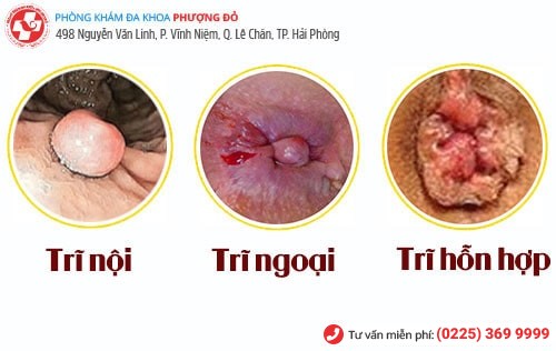 Dấu hiệu bệnh trĩ