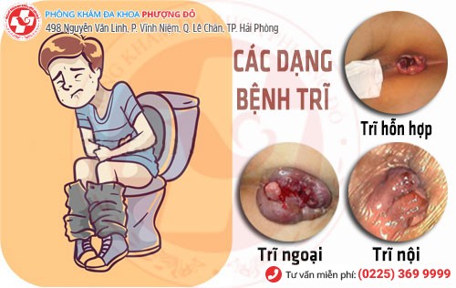 Các dạng bệnh trĩ