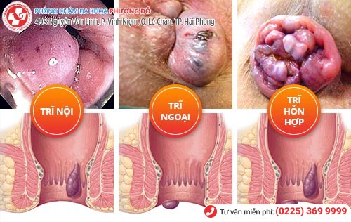 Các Bệnh Hậu Môn Trực Tràng 