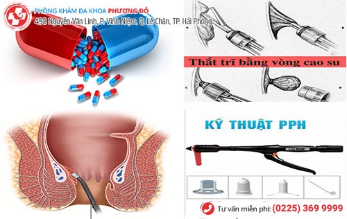 Phương pháp chữa bệnh trĩ