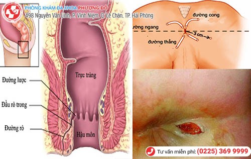 biểu hiện rò hậu môn