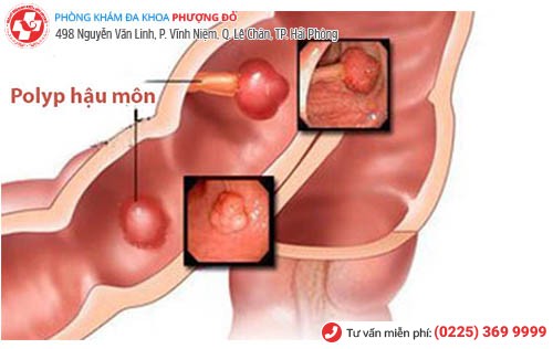 Polyp hậu môn