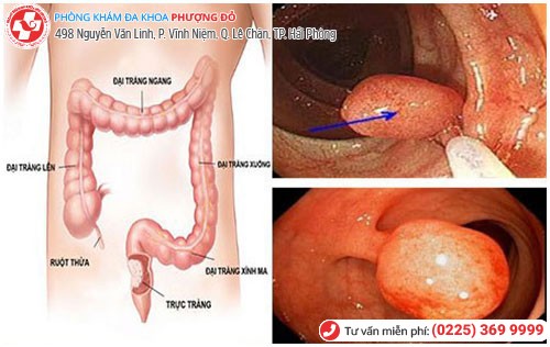 Hình ảnh Polyp hậu môn