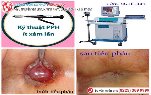 Phương Pháp PPH và HCPT