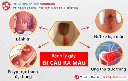 Đi vệ sinh ra máu là dấu hiệu của bệnh gì?