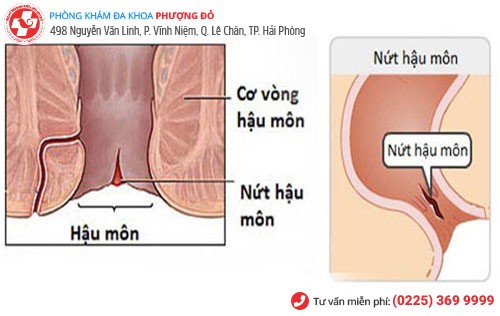 biểu hiện nứt kẽ hậu môn