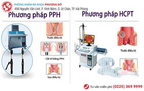 PPH, HCPT - phương pháp cắt trĩ hiệu quả hiện nay