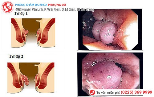 Bệnh trĩ nội