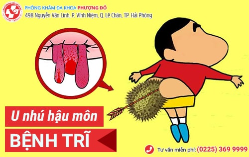 Cẩn trọng với hiện tượng u nhú hậu môn