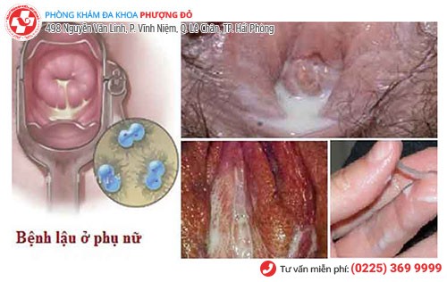 Âm đạo chảy mủ do mắc bệnh lậu