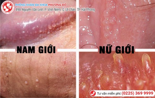 Ảnh hưởng gai sinh dục