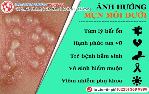 Ảnh hưởng của mụn môi dưới