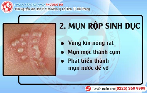 Bệnh hoa liễu mụn rộp sinh dục