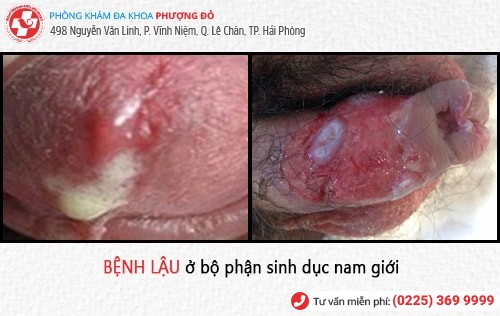 Biểu hiện bệnh lậu – đa số đều không biết đến thông tin này