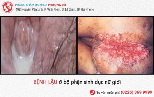 Biểu hiện bệnh lậu – đa số đều không biết đến thông tin này