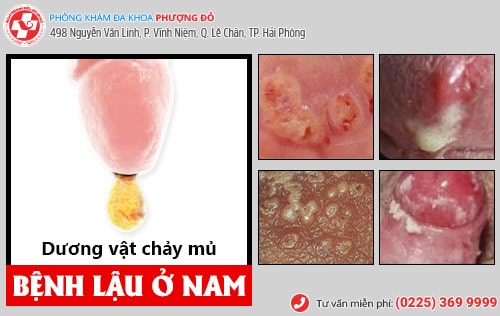 Biểu hiện bệnh lậu ở nam