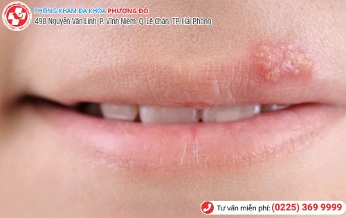 biểu hiện Herpes ở môi