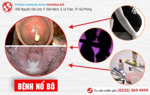 Bệnh nổ bô là gì? Phương pháp chữa bệnh nổ bô an toàn hiện nay