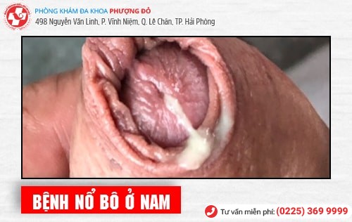 Bệnh nổ bô là gì? Phương pháp chữa bệnh nổ bô an toàn hiện nay