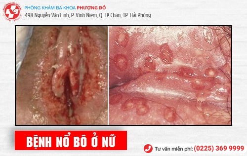 Bệnh nổ bô là gì? Phương pháp chữa bệnh nổ bô an toàn hiện nay