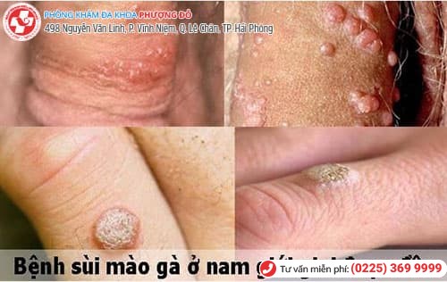 sùi mào gà giai đoạn đầu