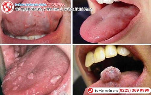 Bị sùi mào gà ở miệng vì quan hệ với trai trẻ