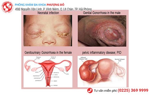 Nhiều biến chứng nguy hiểm khi mắc lậu