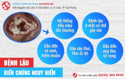 bệnh lậu