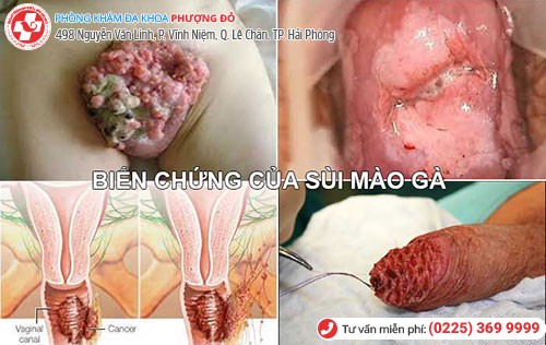 Biến chứng nguy hiểm khi bị sùi mào gà