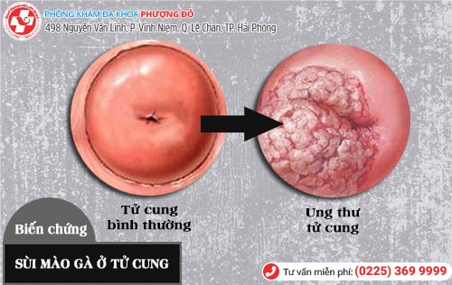 Biến chứng sùi mào gà ở tử cung